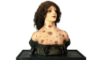 Foorwonder - Vrouw met syfilis