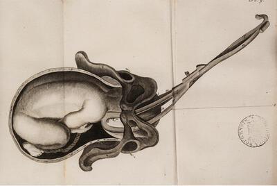 Erfgoedbibliotheek, Didactische plaat in een handboek verloskunde (William Sme/lie, Treatise of ... midwifery ) uit de verzameling van de Brugse geneesheer lsaac De Meyer (1786-1861).
