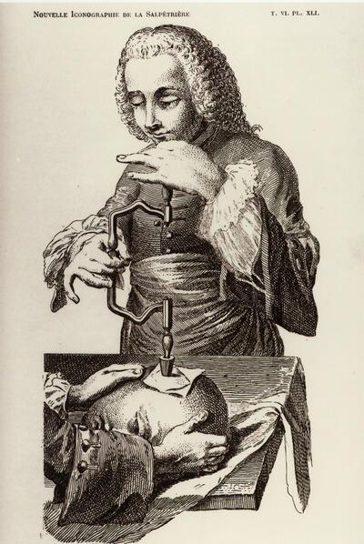 Trepanatie. Gravure uit: Nouvelle Iconographie de la Salpétrière, Parijs (Collectie Museum Dr. Guislain)