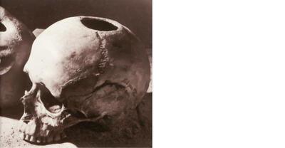 Getrepaneerde schedel, Guislain,
