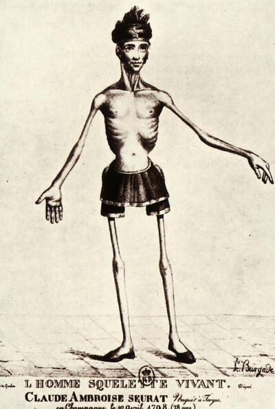 Claude Ambroise Seurat, geboren in 1798, levend skelet. Litho naar I. Burgade, in: Aesculape, 1826 (Collectie Museum Dr. Guislain)