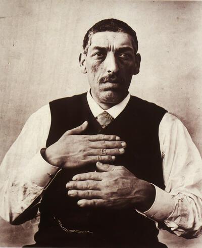 Acromegalie (ziekelijke vergroting van de lichaamsuiteinden). Foto A. Londe, uit: Nouvelle lconographie de la Salpétrière, deel 1, plaat 35, Parijs (Collectie Museum Dr. Guislain)